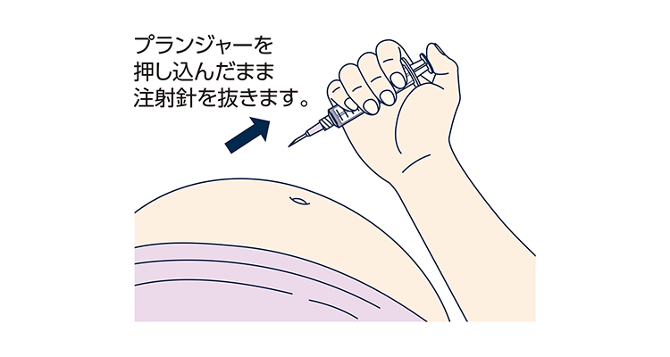 その他の注射筒の持ち方