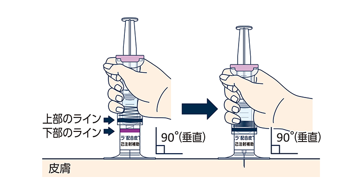 利き手で注射筒をもち、皮膚の「テント」の真ん中に注射針を45度～90度の角度※で優しく刺します。