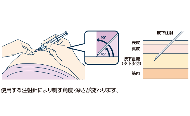 利き手で注射筒をもち、皮膚の「テント」の真ん中に注射針を45度～90度の角度※で優しく刺します。