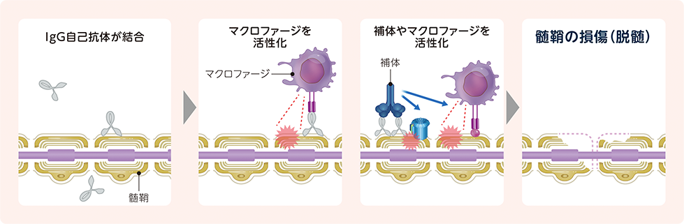 脱髄の原因について