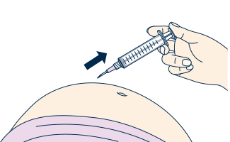 薬液を全量注入したことを確認した後に、皮膚をつまんでいた手をはなし、注射針を刺した角度と同じ角度で抜きます。