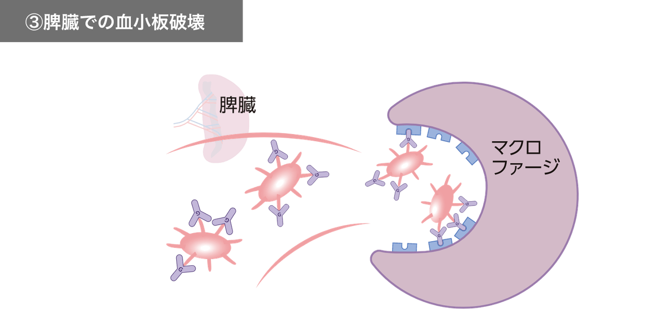 脾臓での血小板破壊